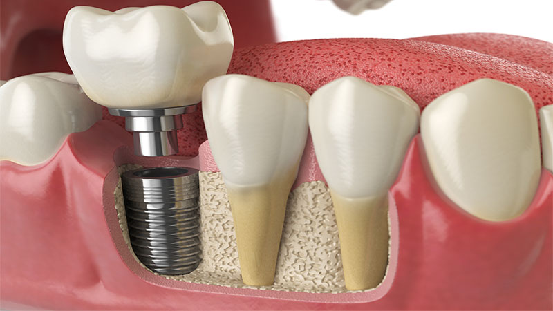 Anatomy Of Healthy Teeth And Tooth Dental Implant In Human Denturra.