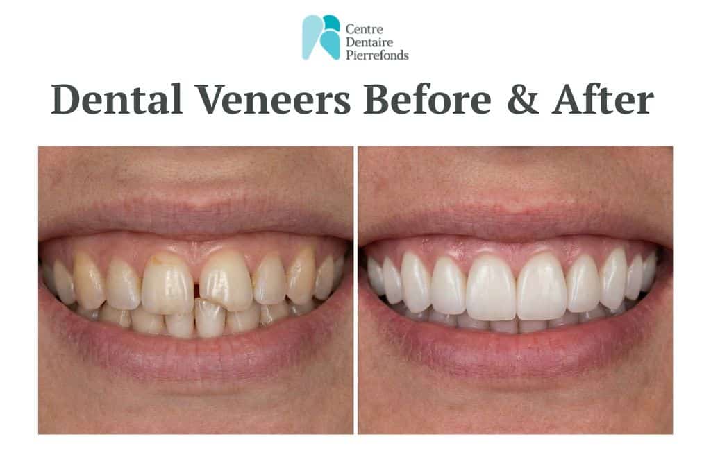 dental veneers before and after dental veneers before and after