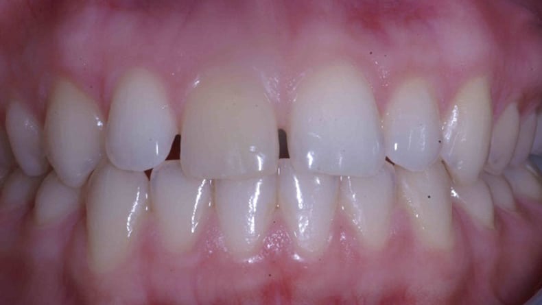 Blanchiment-et-facette-en-resine-pour-fermeture-de-diasteme-1