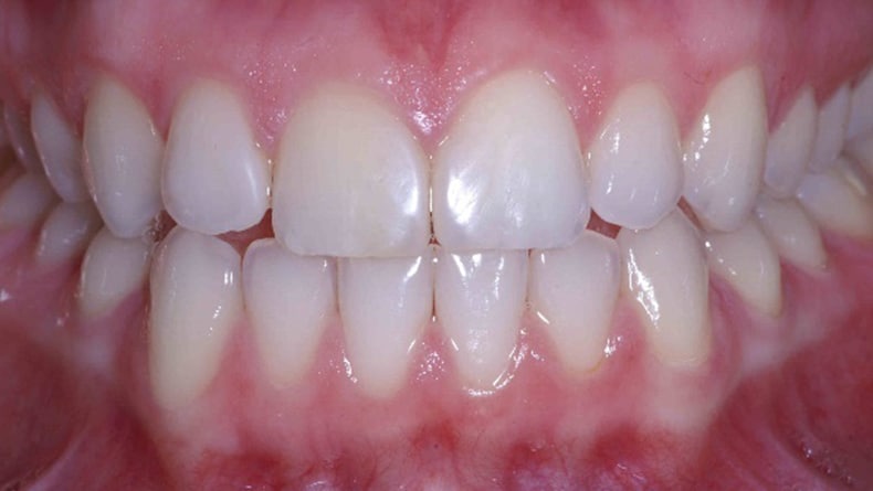 Blanchiment-et-facette-en-resine-pour-fermeture-de-diasteme-2
