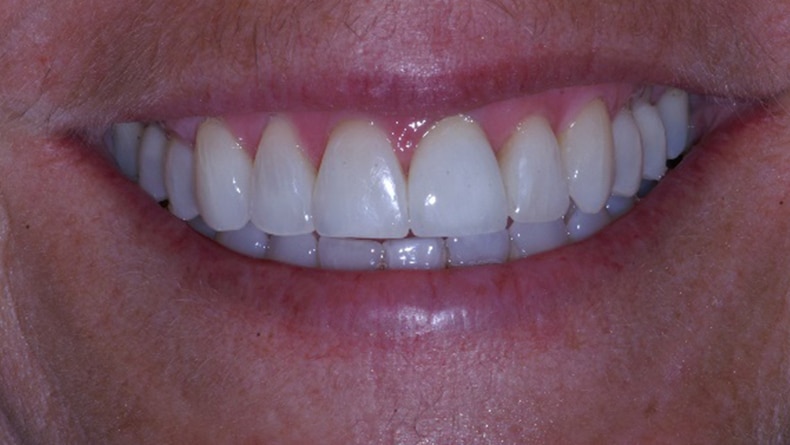 Couronne-Porcelaine-dent-du-haut-2