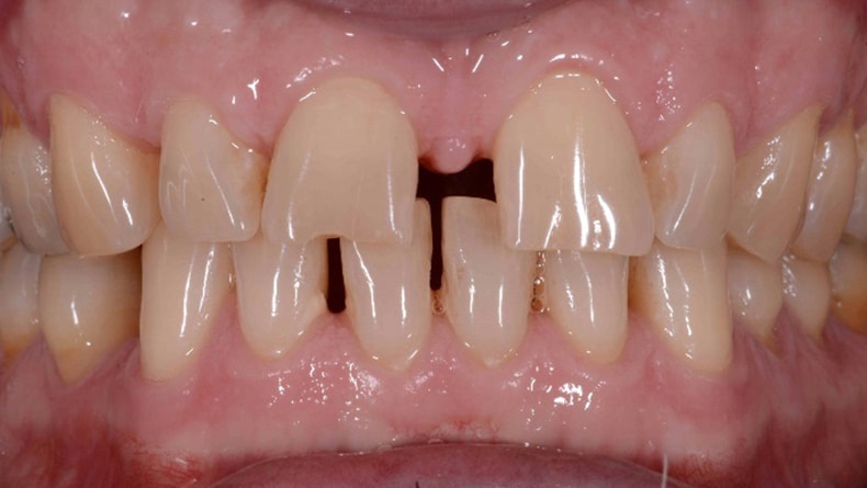 Couronnes-anterieur-du-haut-en-porcelaine-(Reduction-de-lespace-entre-les-dents)-1