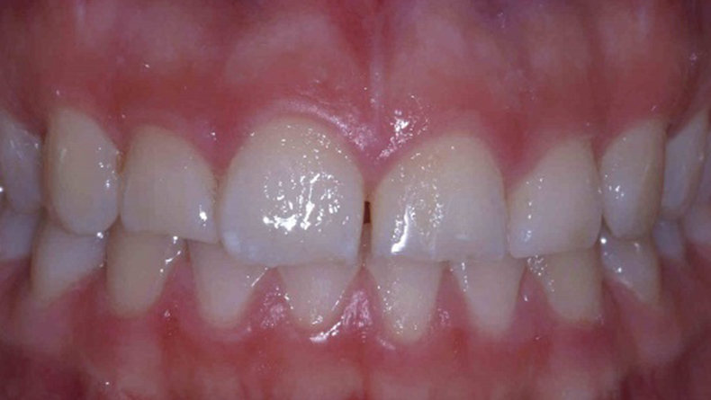 Facette-de-porcelaine,-centrale-et-laterale-du-haut-(correction-longueur-des-dents-et-fermeture-de-diasteme)-1