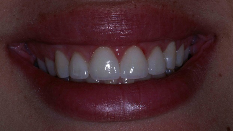 Facette-de-porcelaine,-centrale-et-laterale-du-haut-(correction-longueur-des-dents-et-fermeture-de-diasteme)-2