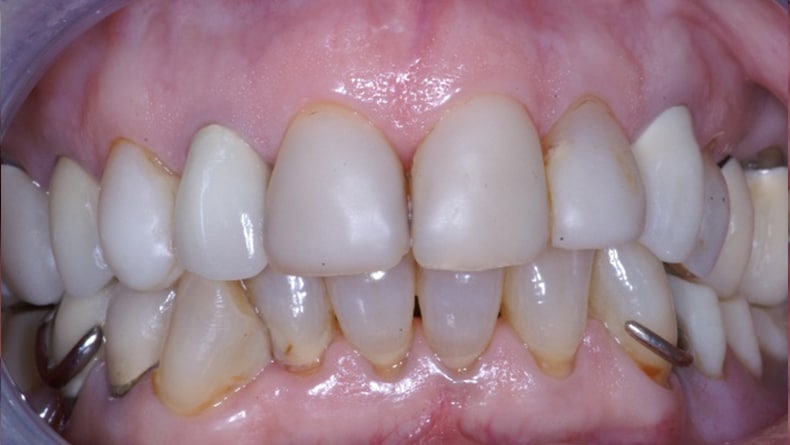 Rehabilitation-complete-du-haut-couronne-porcelaine-1
