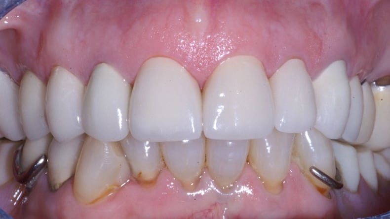 Rehabilitation-complete-du-haut-couronne-porcelaine-2