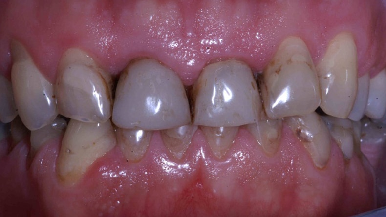 Rehabilitation-complete-haut-et-bas-couronne-porcelaine-1