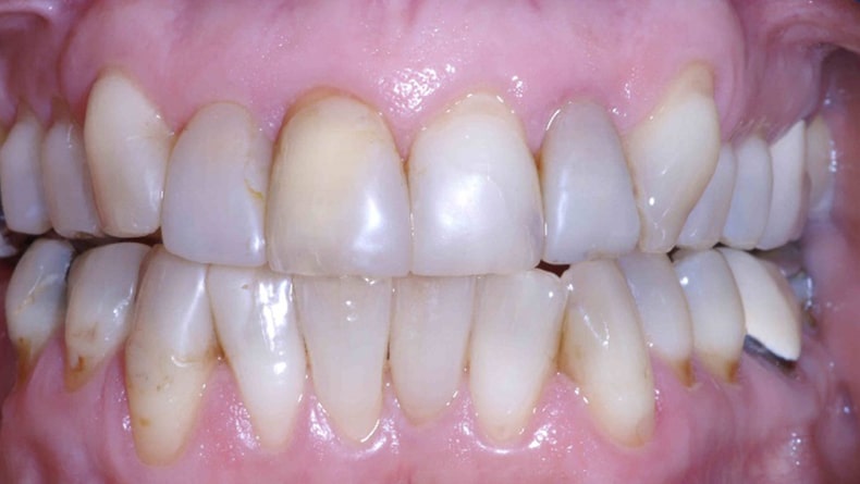 Rehabilitation-du-haut-couronne-porcelaine-premolaire-a-premolaire-1