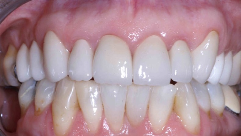 Rehabilitation-du-haut-couronne-porcelaine-premolaire-a-premolaire-2