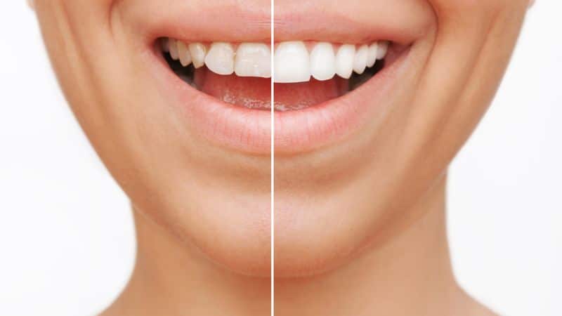 Soins Esthétiques Dentaires Pour Améliorer Votre Sourire
