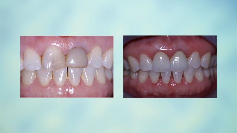 Soins Esthétiques Dentaires Pour Améliorer Votre Sourire