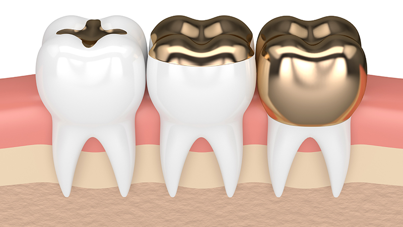 Gold Fillings And Gold Crowns