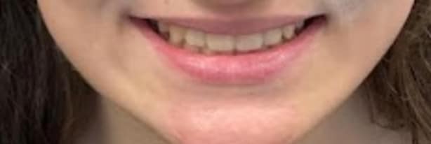 invisalign-1 AFTER