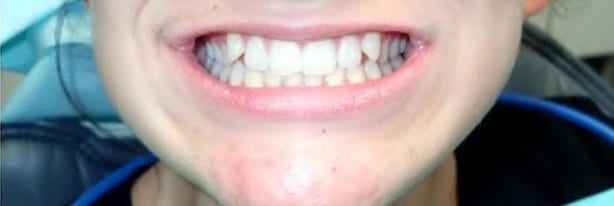 invisalign-1 BEFORE