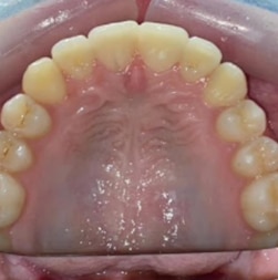 invisalign-2 AFTER