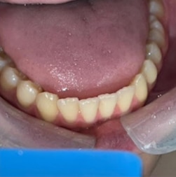 invisalign-3 AFTER