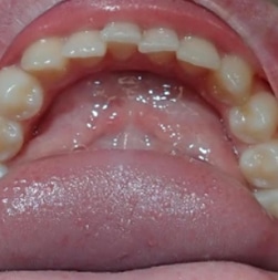 invisalign-3-BEFORE