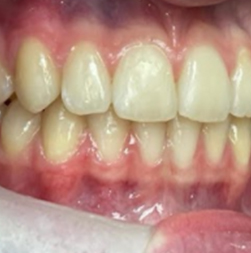 invisalign 4 AFTER