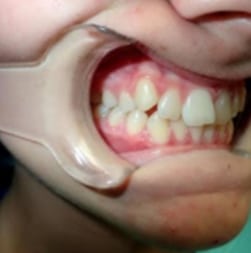 invisalign 4 BEFORE
