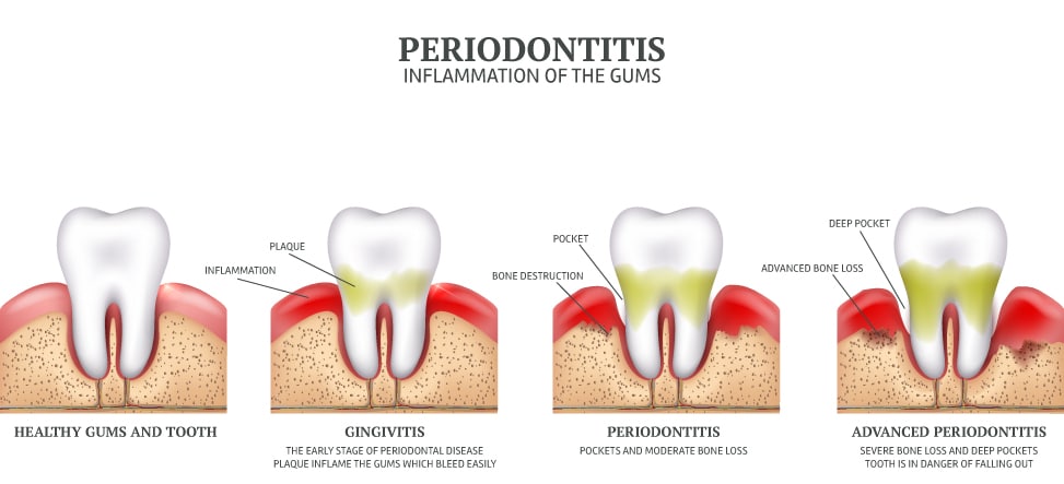 Periodontitis