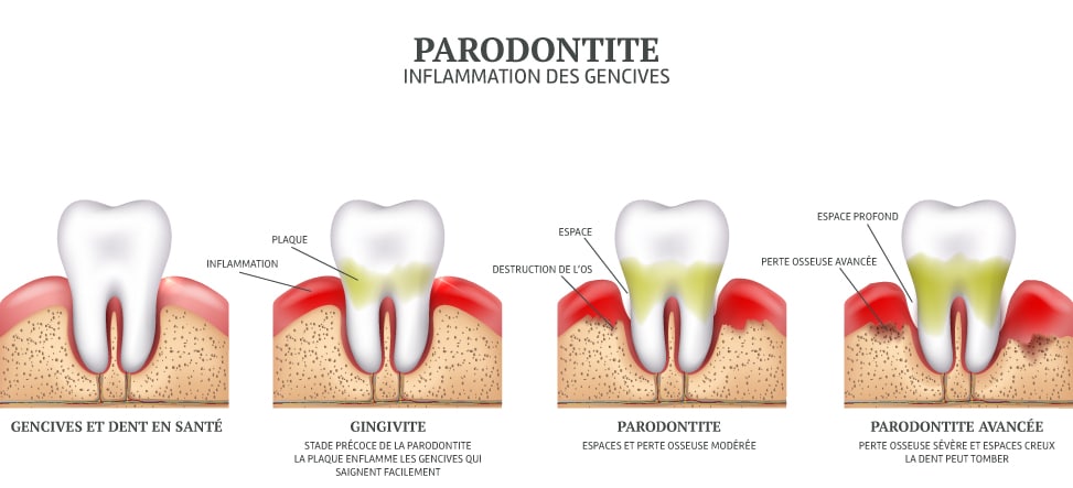 CDP_Periodontitis_FR