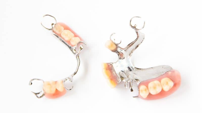 Cast metal partial dentures