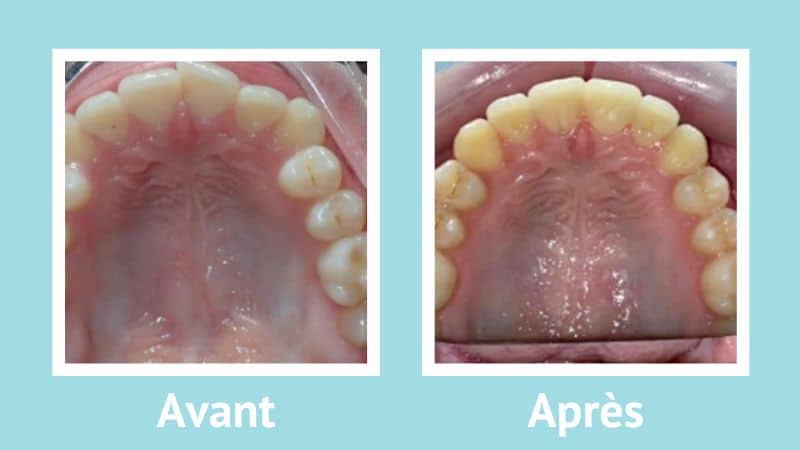 Avant Apres Invisalign