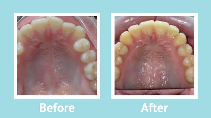 Before and after Invisalign