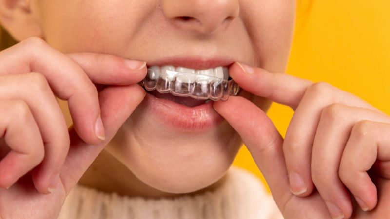 Invisalign Treatment What You Should Know