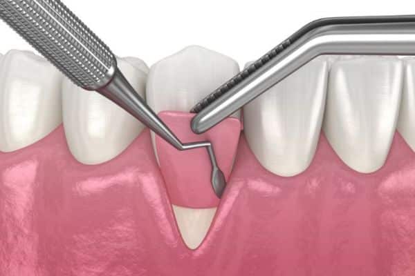 Gum grafts for receding gums